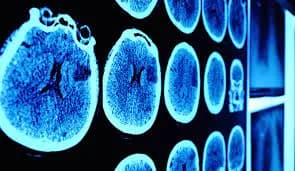 NeuroSight thumbnail